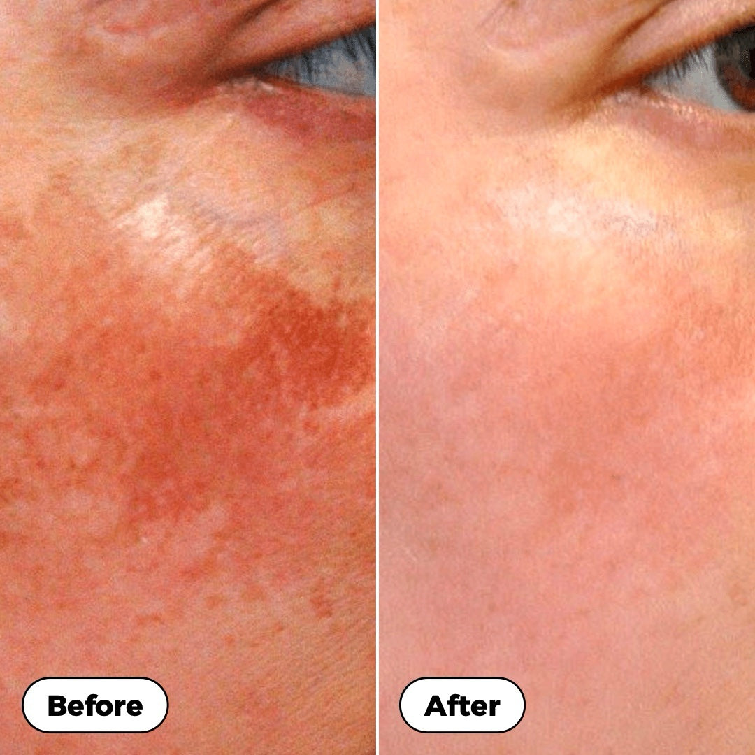 Before and after: redness and dark spots on the cheek look visibly clearer